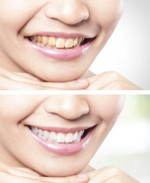 Teeth Whitening Sutton